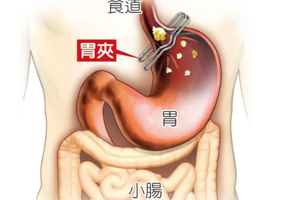 胃在什么位置图片：左上腹肋骨以下 体型不同位置不同