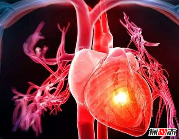 心脏病是怎么引起的?心脏病人的十大注意事项