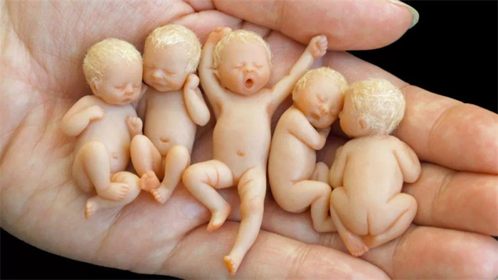 人类最小婴儿  出生时不到1斤  医生说活不过3个月  如今怎么样了