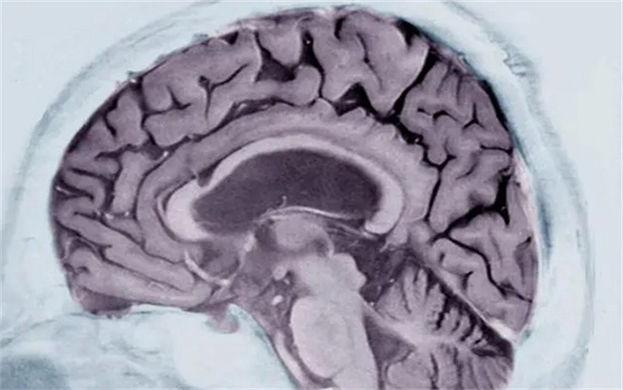 新技术：核磁共振扫描即可确诊阿兹海默症