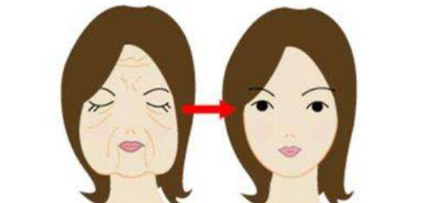 拉皮的危害有哪些 可能导致神经受损表情不自然(图4)