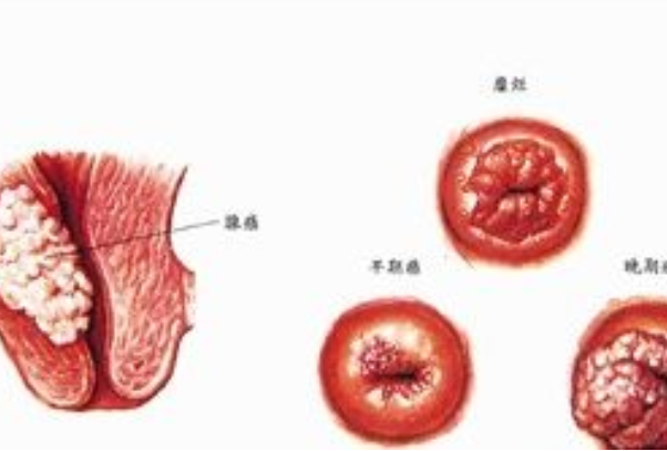 宫颈癌早期照片图片