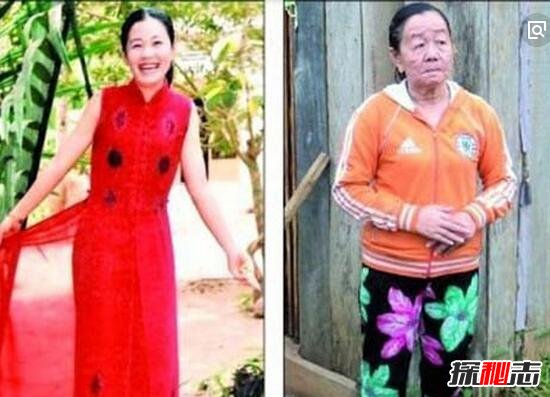 23歲越南少女瞬間衰老70歲/科學無解罕見閃電衰老之謎