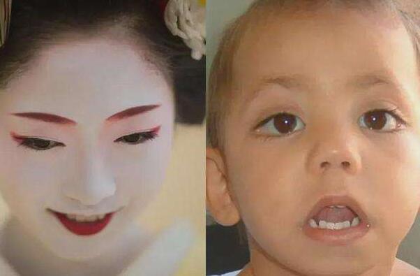 歌舞伎脸谱症症状图片