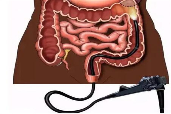 肠镜6张图片对应部位图片