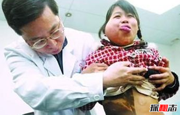 广州女孩患骨膜增生厚皮症,面部褶皱如古稀老人(染色体显性遗传)