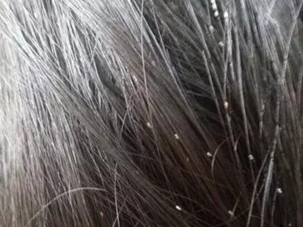 虱子怎么长出来的?虱子分别有哪几种(图7)