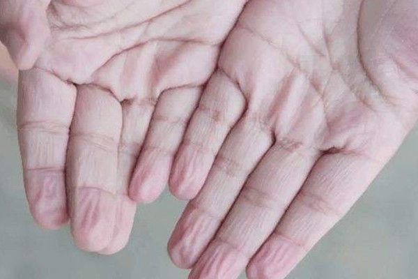 为什么洗澡时手会皱?手部皮下脂肪少(有利于抓握湿物)(图2)