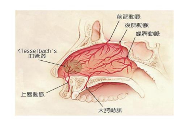 为什么鼻子总爱出血?鼻部或全身疾病所致(鼻腔血管破裂)(图2)