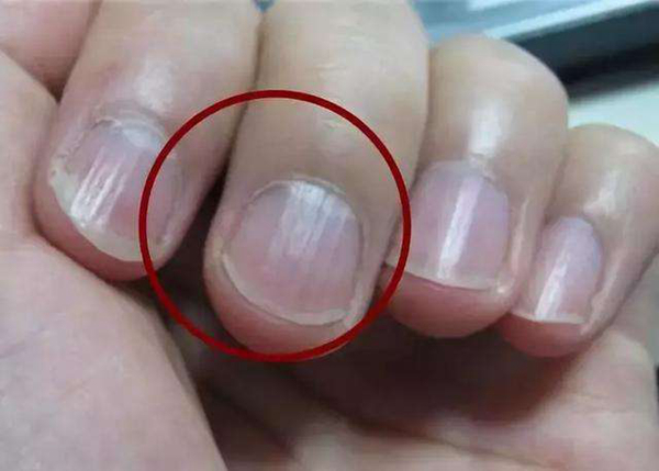 指甲上的月牙是什么?月牙少是不是身体不好(图6)