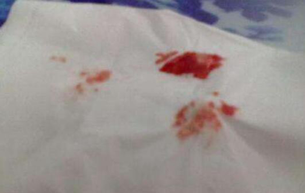 辐射病是什么病?有哪些症状证明被辐射了(图3)