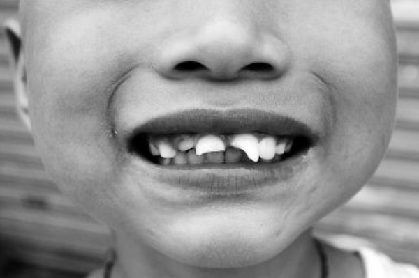 世界上牙齿最尖的人图片