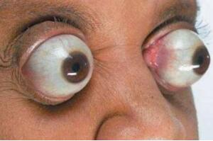 世界上眼球最突出的女人，金・古德曼（眼睛凸出11毫米）