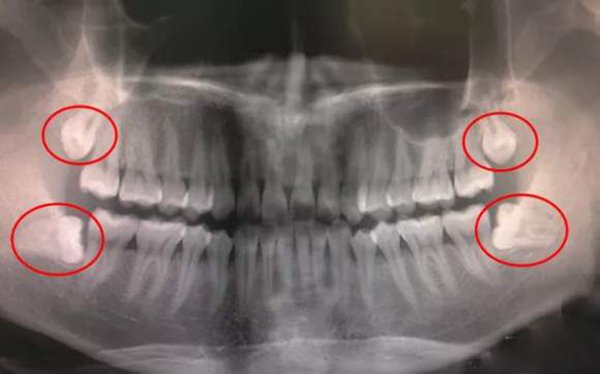 智齿拔掉后有个洞怎么办?拔牙之后应该注意什么(图1)