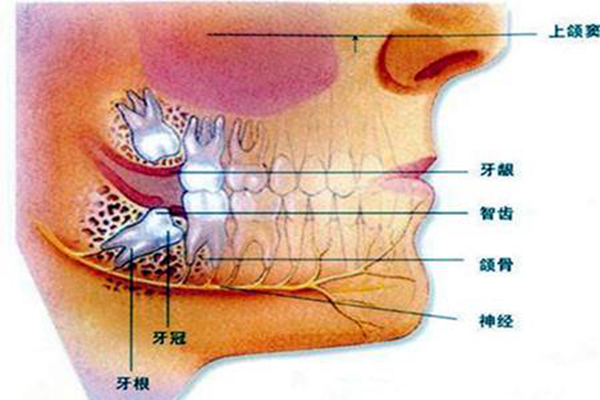 智齿拔掉后有个洞怎么办?拔牙之后应该注意什么(图2)