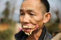 世界上牙齿最多的人 来自印度的小男孩（拥有526颗牙）