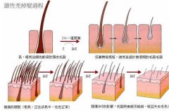 脱发是什么原因引起的?与遗传因素有关，预兆身体有疾病